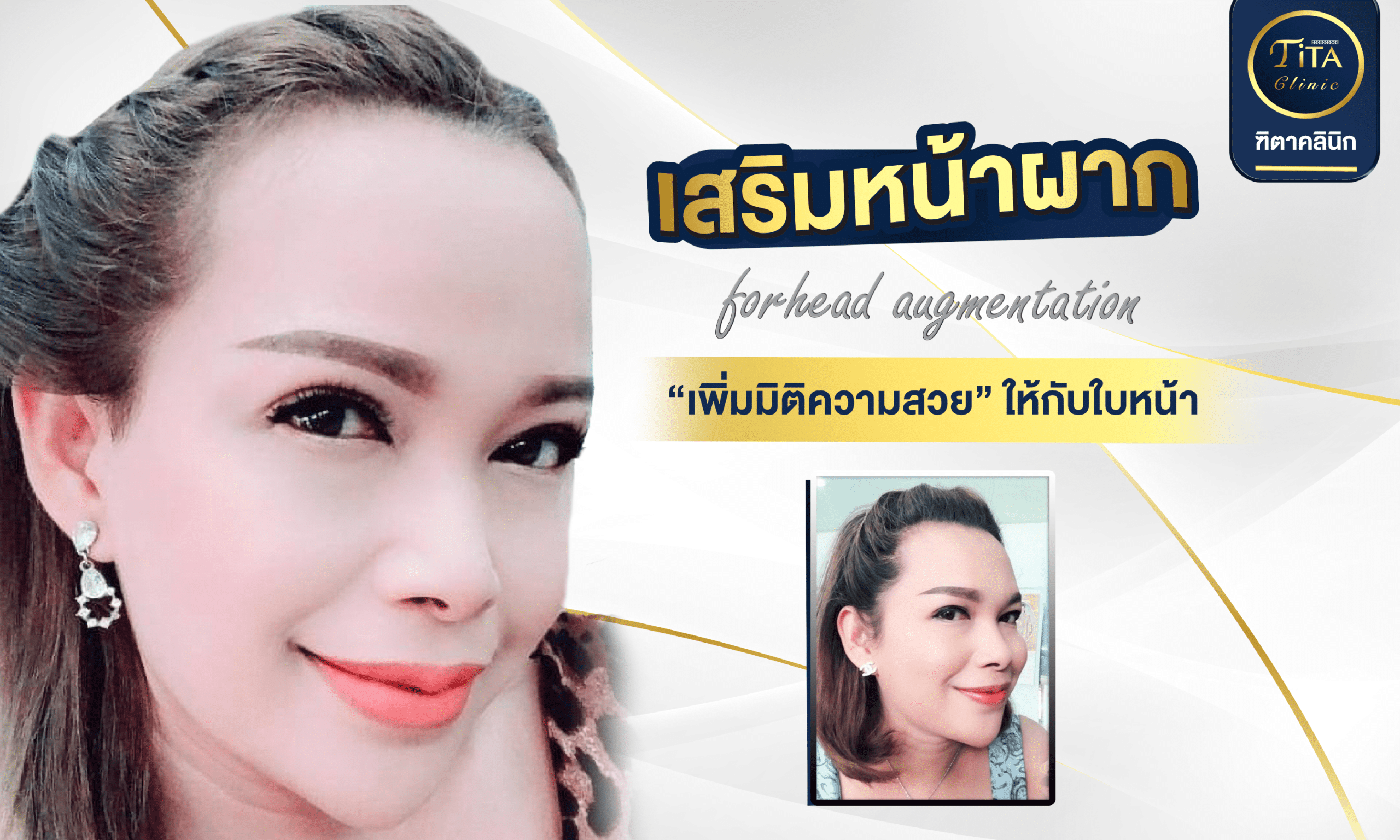 เสริมหน้าผาก_cover_01