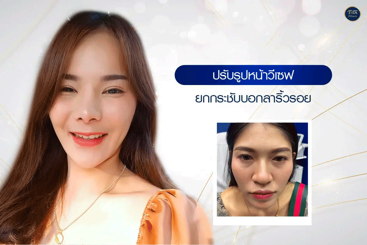 ลบริ้วรอย