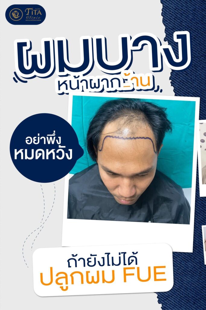 ปลูกผม ที่ไหนดี, ปลุกผม FUE, คลินิกปลูกผม