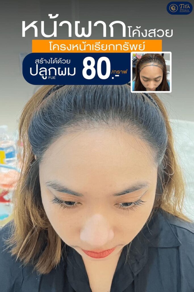 ปลูกผม ที่ไหนดี, ปลุกผม FUE, คลินิกปลูกผม