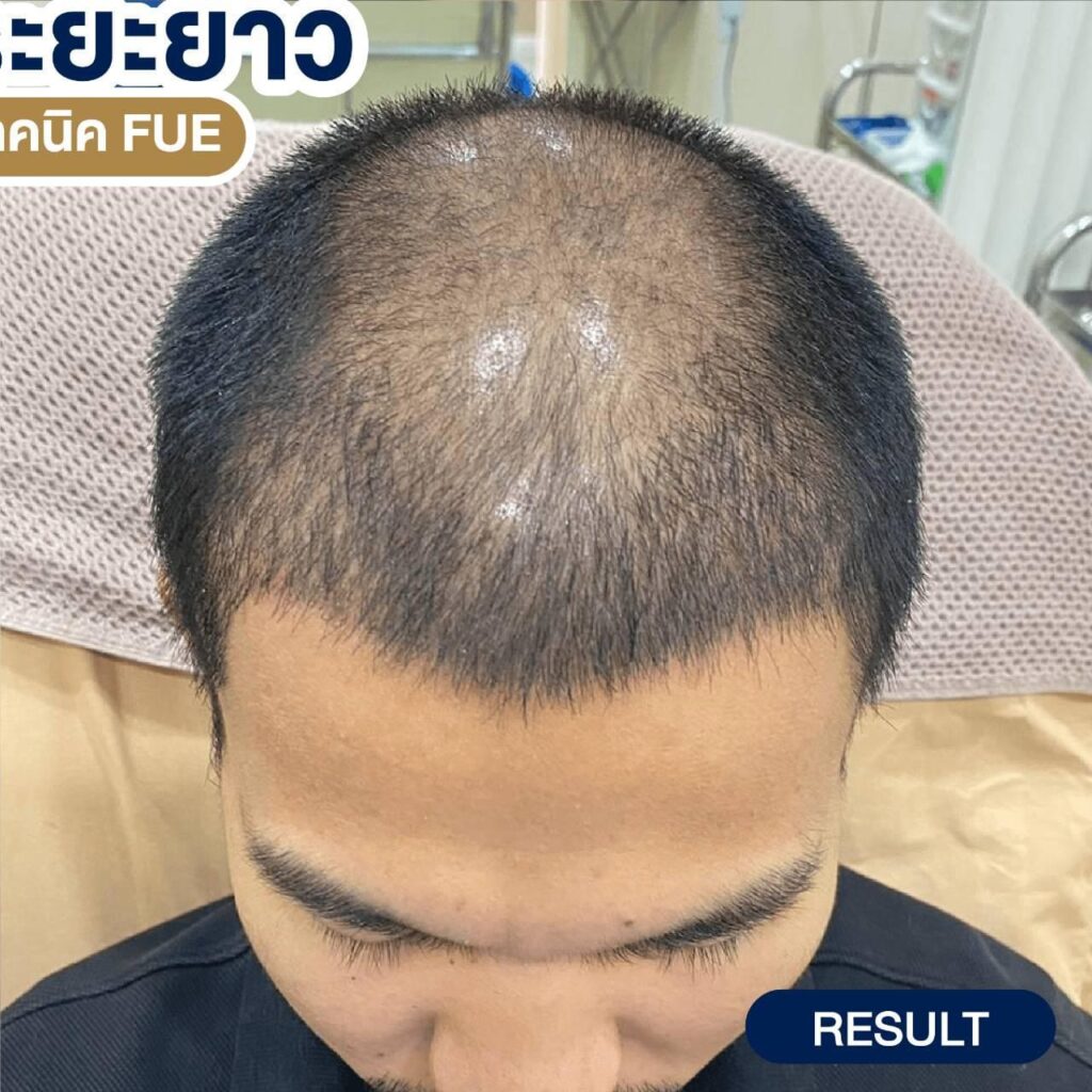 ปลูกผม ที่ไหนดี, ปลุกผม FUE, คลินิกปลูกผม