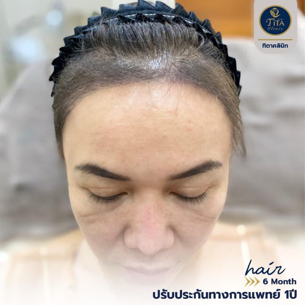 ปลูกผม ที่ไหนดี, ปลุกผม FUE, คลินิกปลูกผม