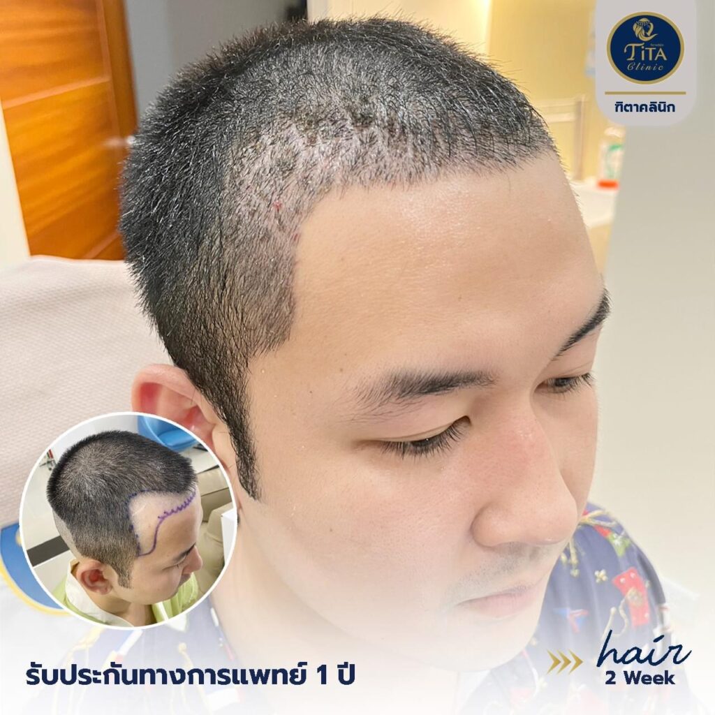ปลูกผม ที่ไหนดี, ปลุกผม FUE, คลินิกปลูกผม