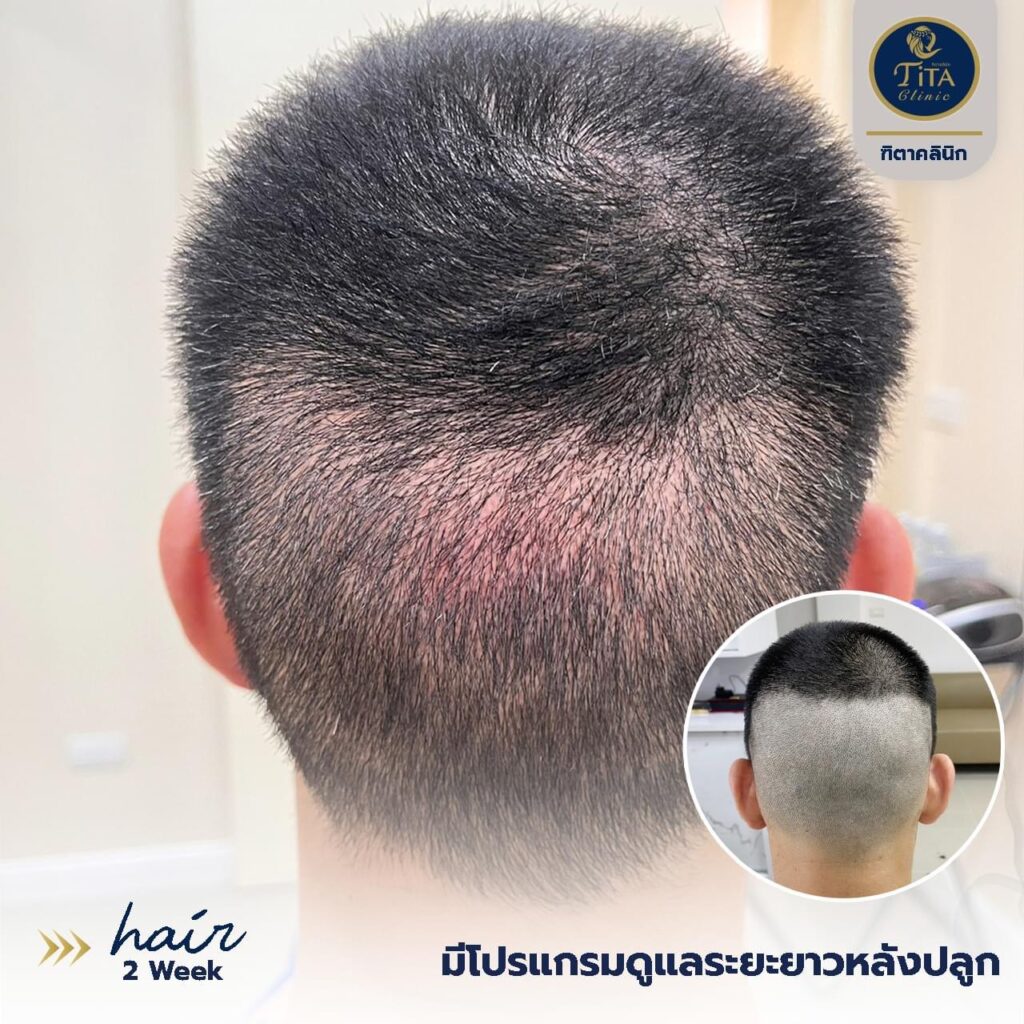 ปลูกผม ที่ไหนดี, ปลุกผม FUE, คลินิกปลูกผม