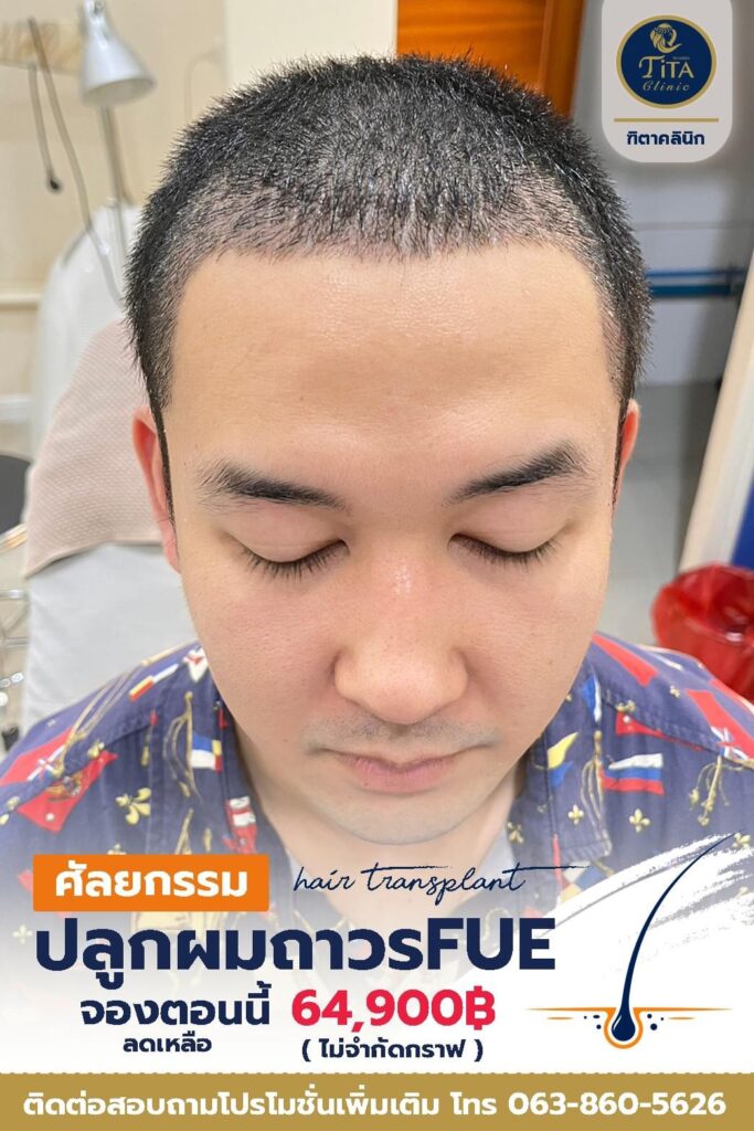 ปลูกผม ที่ไหนดี, ปลุกผม FUE, คลินิกปลูกผม