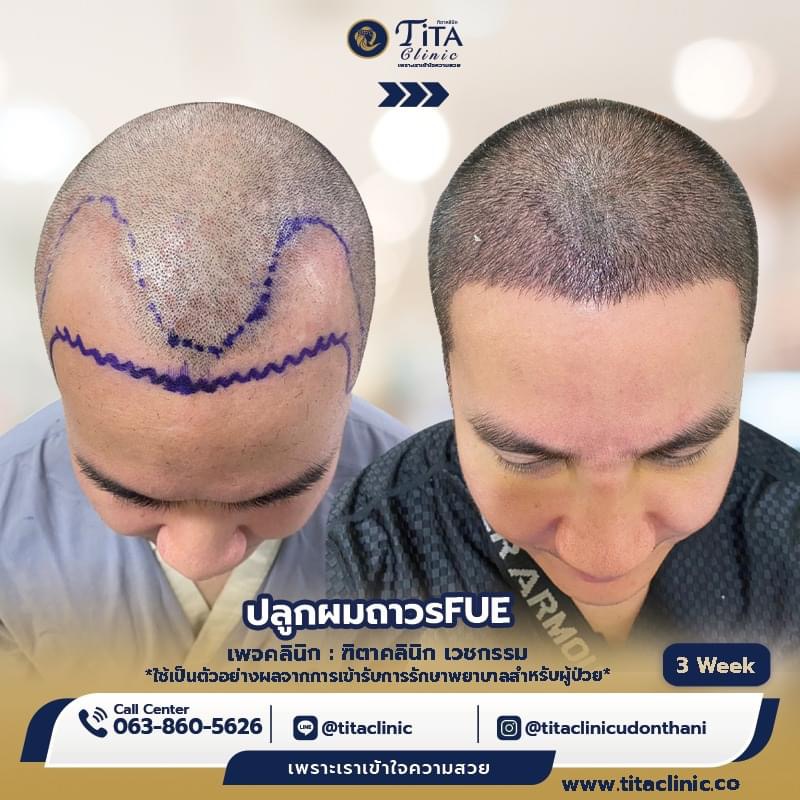 ปลูกผม ที่ไหนดี, ปลุกผม FUE, คลินิกปลูกผม