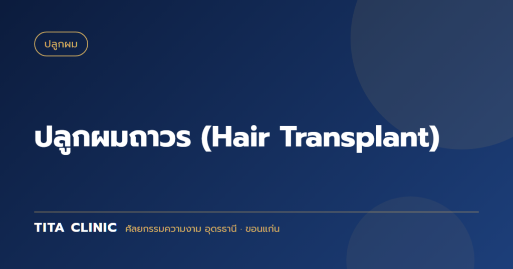 ปลูกผมถาวร (Hair Transplant)